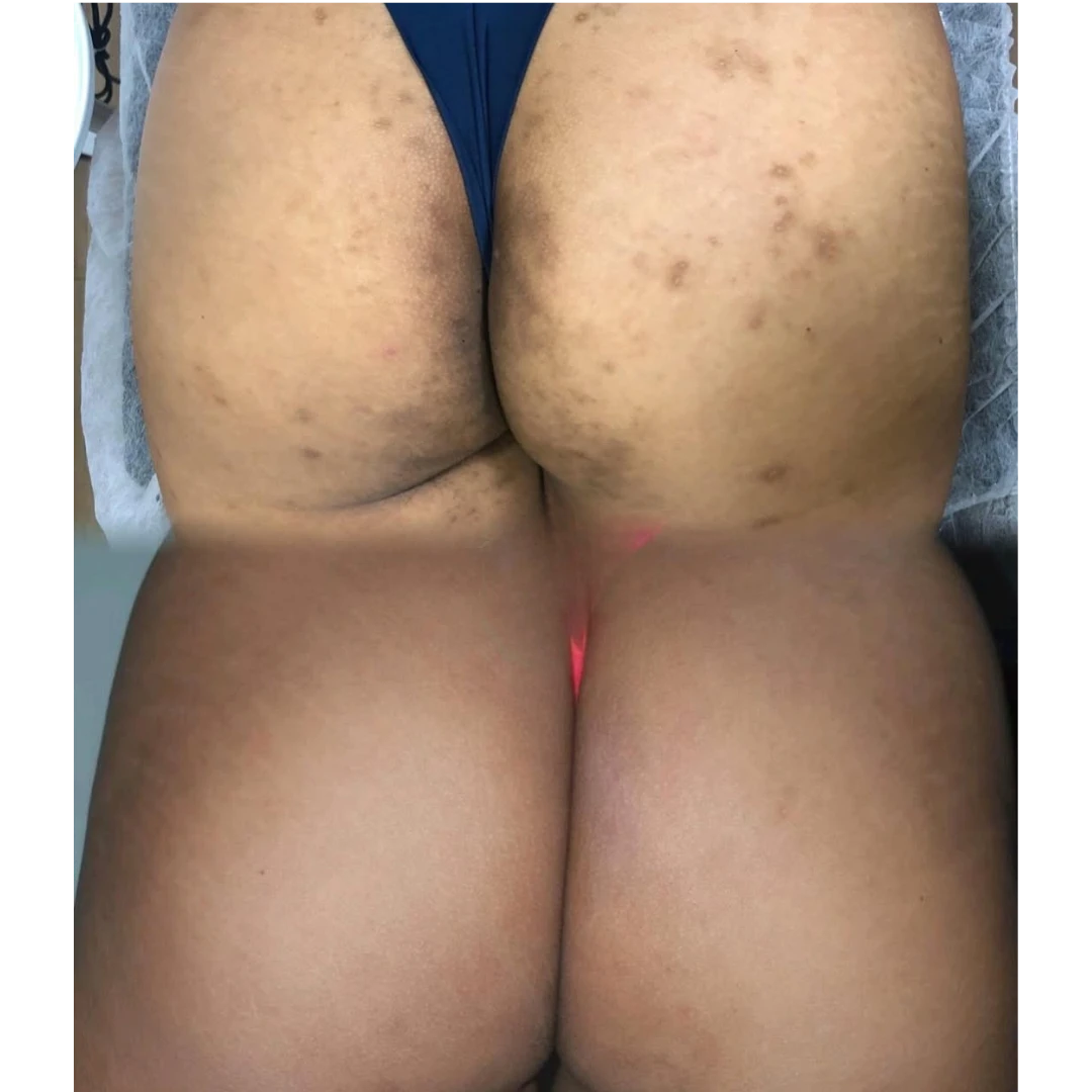 Resultado real: glúteos com manchas antes (em cima) e depois (embaixo) do tratamento Floríntima