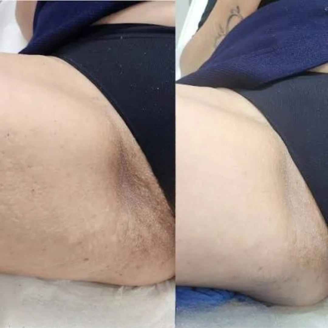 Resultado real: virilha antes (à esquerda) e depois (à direita) do tratamento Floríntima